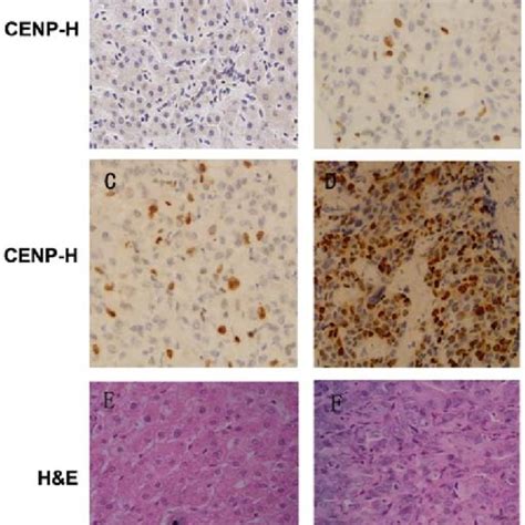 Representative Immunohistochemistry Results Of Cenp H Expression In Hcc