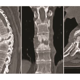 MRI Thoracic Spine T10 T11 Discitis With Minimal Soft Tissue Component