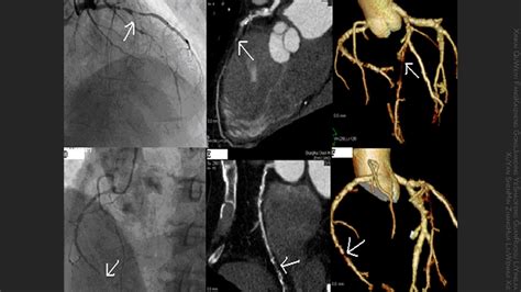 Complete Coronary Revascularization One Definition To Unite Them All