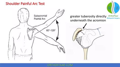 Shoulder Painful Arc Test Easily Explained OrthoFixar 2025