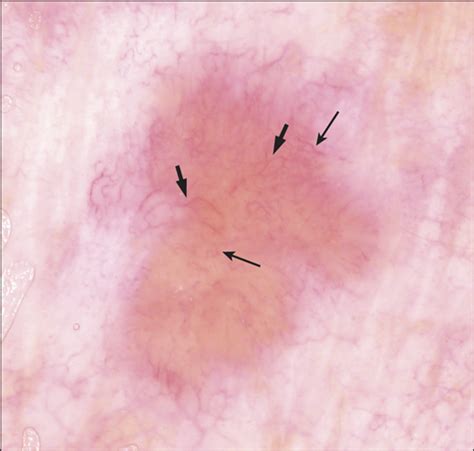 Dermoscopic Evaluation Of Amelanotic And Hypomelanotic Melanoma