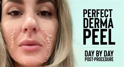 Perfect Derma Peel Types Aftercare And Benefits