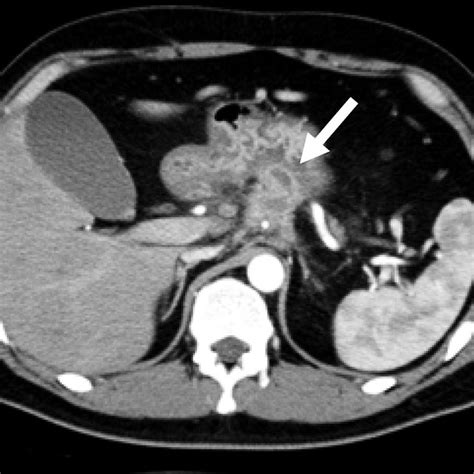 Gastrography showing a fistula between the pancreatic abscess and ...