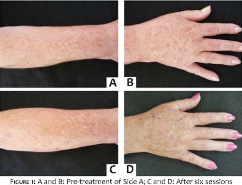 Figure 1 From Comparative Study Of The Treatment Of Large Actinic