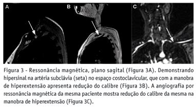 SciELO Brasil Estudo por imagem da síndrome do desfiladeiro