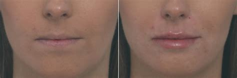 Lip Enhancement Photos | Houston, Tx | Patient 10478