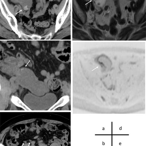 Pdf Emergency Laparoscopic Ileocecal Resection For A Low Grade