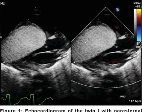 Figure 1 From Cardiac Tumors In Both Twins A Case Report Of A Rare