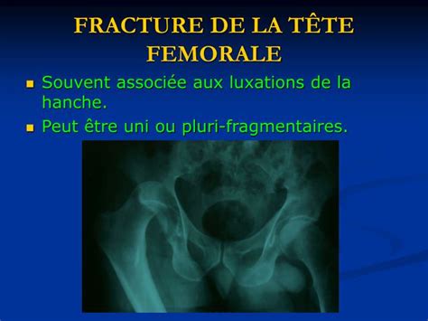 Ppt Fractures De Lextremite Superieure Du Femur Powerpoint