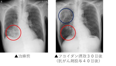 臨床例③：ステージⅢcの肺がんの遠隔リンパ節転移（69歳男性） フコイダンラボ