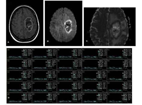 Left Parietal High Grade Glioma Anaplastic Astrocytoma WHO Grade III