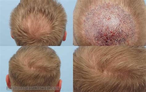 Dr Bessam Farjo Hair Transplant Procedure Before And After Result