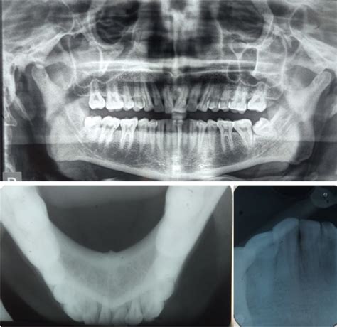 Opg Occlusal Radiograph Of Mandible And Iopar 41 42 Download Scientific Diagram