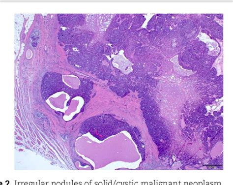 Figure From A Malignant Spiradenoma Of The Forehead A Case Report