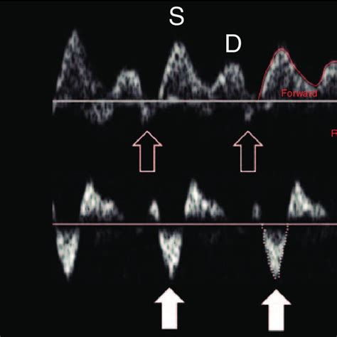 M Mode Fetal Echocardiogram Shows Both Fast Atrial And Ventricular