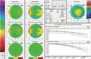 The D Parameters In A Normal Thin Cornea With Central Corneal Thickness