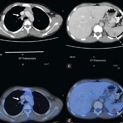 Transaxial And Sagittal Contrast Enhanced Computed Tomography A And C