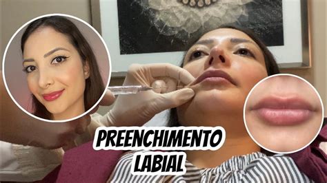 Preenchimento Labial Antes E Depois 1 Ml De ácido Hialurônico Youtube