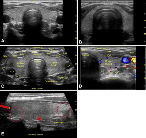 Labeled Thyroid Ultrasound