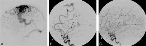 Figure 1 From Embolization Of Residual Fistula Following Stereotactic Radiosurgery In Cerebral