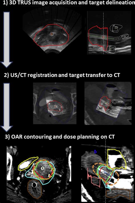 Combining Transrectal Ultrasound And Ct For Image Guided Adaptive Brachytherapy Of Cervical