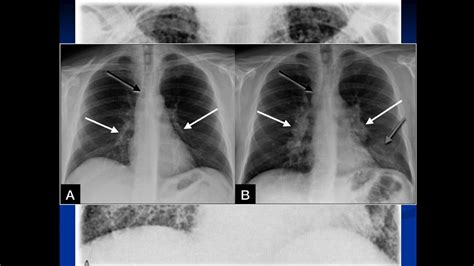 Seminario De Síndromes Pulmonares Radiología Pulmonar Dr Alejandro