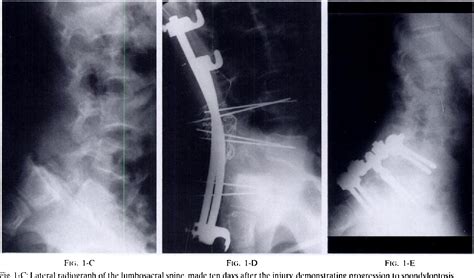 Figure 1 From Acute Spondylolytic Spondylolisthesis Semantic Scholar