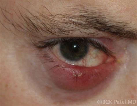 Moran Core What Is A Chalazion And How Do You Treat It The Many Faces Of Chalazia