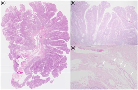 Pathology Hematoxylin And Eosin Stain A Low‐power View Of The