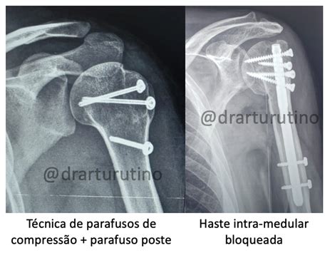 Fratura do úmero proximal Cabeça do úmero Dr Artur Utino Membro do