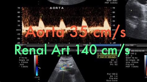 Tmt Renal Doppler Part Iv Renal To Aortic Ratio Youtube