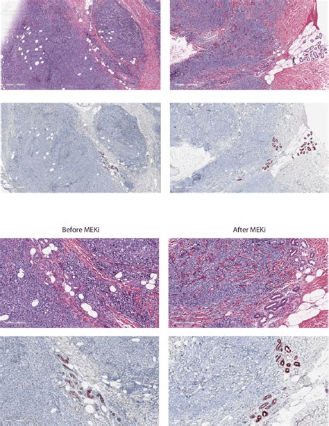 Example Of Ido Expression Increasing After Targeted Therapy A