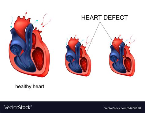 Heart Disease Defect Royalty Free Vector Image