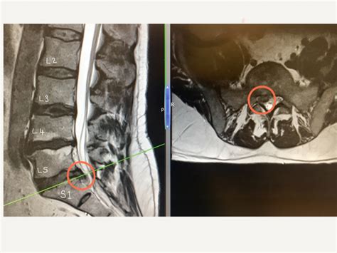 Lumbar Disc Prolapse Spines Dorset