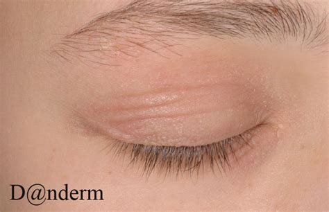 Atopic Dermatitis Eyelid Pictures Photos