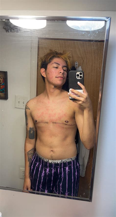 1 Month And 1 Week Post Op Anyone Know Why My Chest Gets A Little Irritated After A Shower R