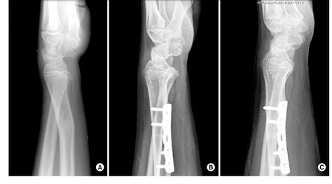 Figure 2 From Anatomic Reconstruction Of The Distal Radioulnar Ligament