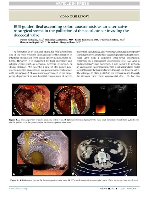 Pdf Eus Guided Ileal Ascending Colon Anastomosis As An Alternative To Surgical Stoma In The