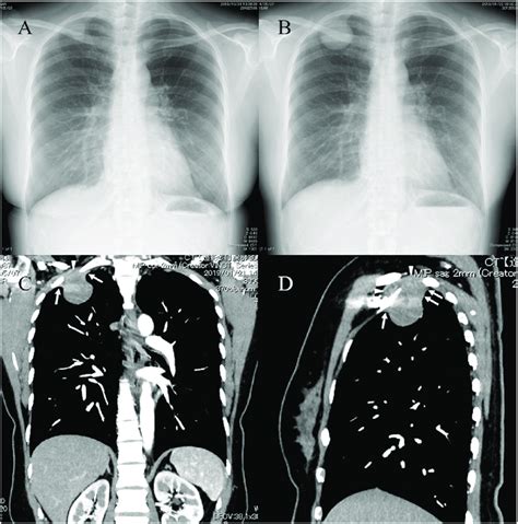 Radiographic Findings Of Case Fig A B Show Chest Xp Months