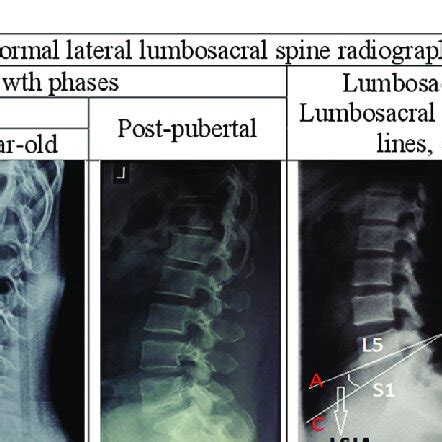 Normal Lateral Lumbosacral Spine Radiographs Showing Some Growth Phases