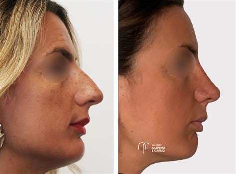 Rinoplastia Clínica Do Nariz E Face Especialistas Em Face