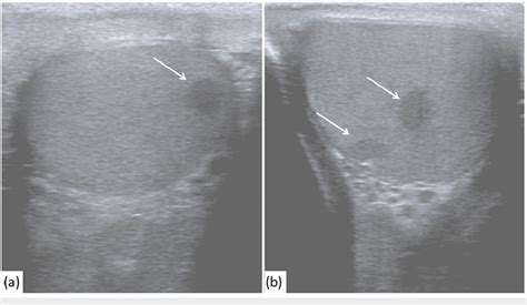 Scrotal Ultrasonography With Multiple Rounded Hypoechoic Lesions In