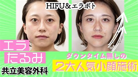 【エラボトックス×hifuコンビ】「顔小さくなりすぎ！」注射と照射一緒にやってみたらヤバかった【共立美容外科 新宿本院】 Youtube