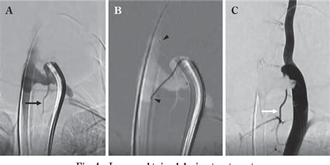 Figure From A Case Of Lower Cervical Vertebro Vertebral Arteriovenous