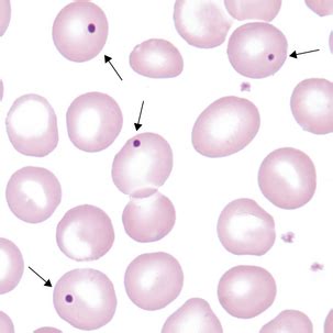 Inclusions In Erythrocytes Clinical Gate