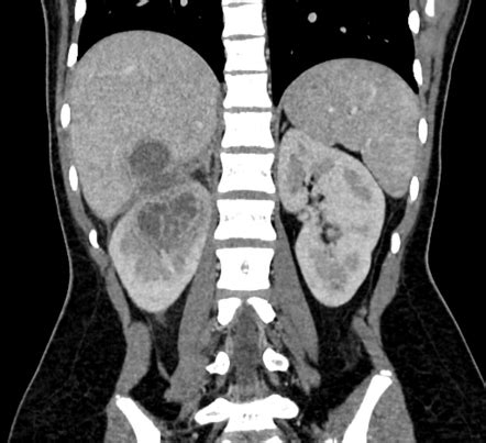 Renal Abscess Ultrasound