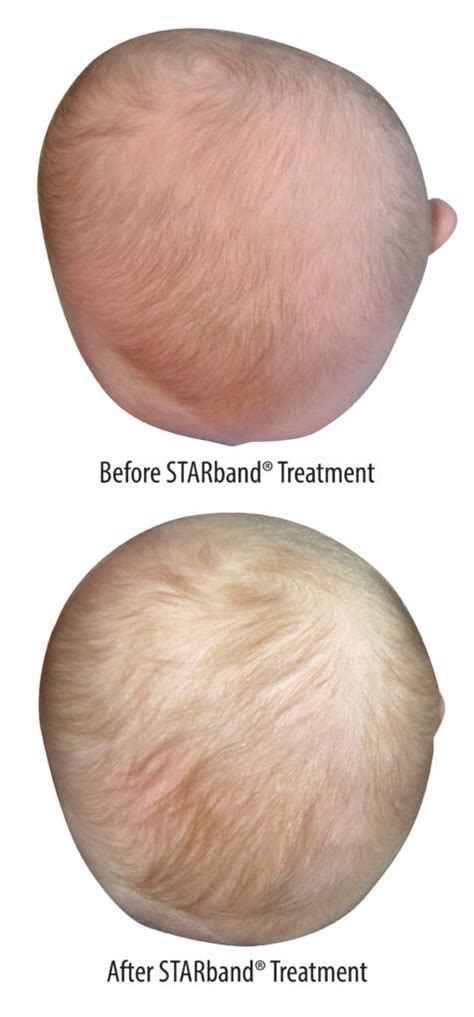 Plagiocephaly | Maughan Prosthetics and Orthotics