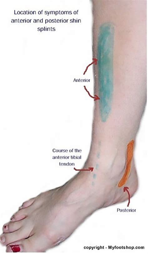 Shin Splints | Causes, contributing factors and treatment options | MyFootShop.com