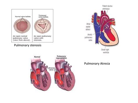 PULMONARY VALVE DISEASES (2).pptx