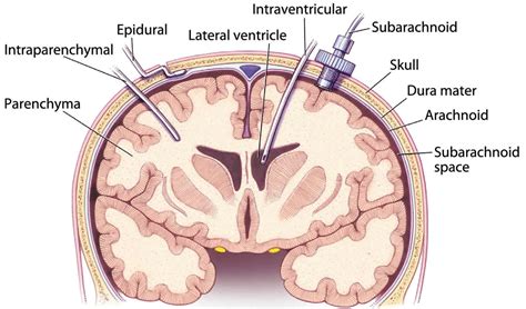 Intracranial Pressure High Intracranial Pressure Causes Symptoms And Treatment